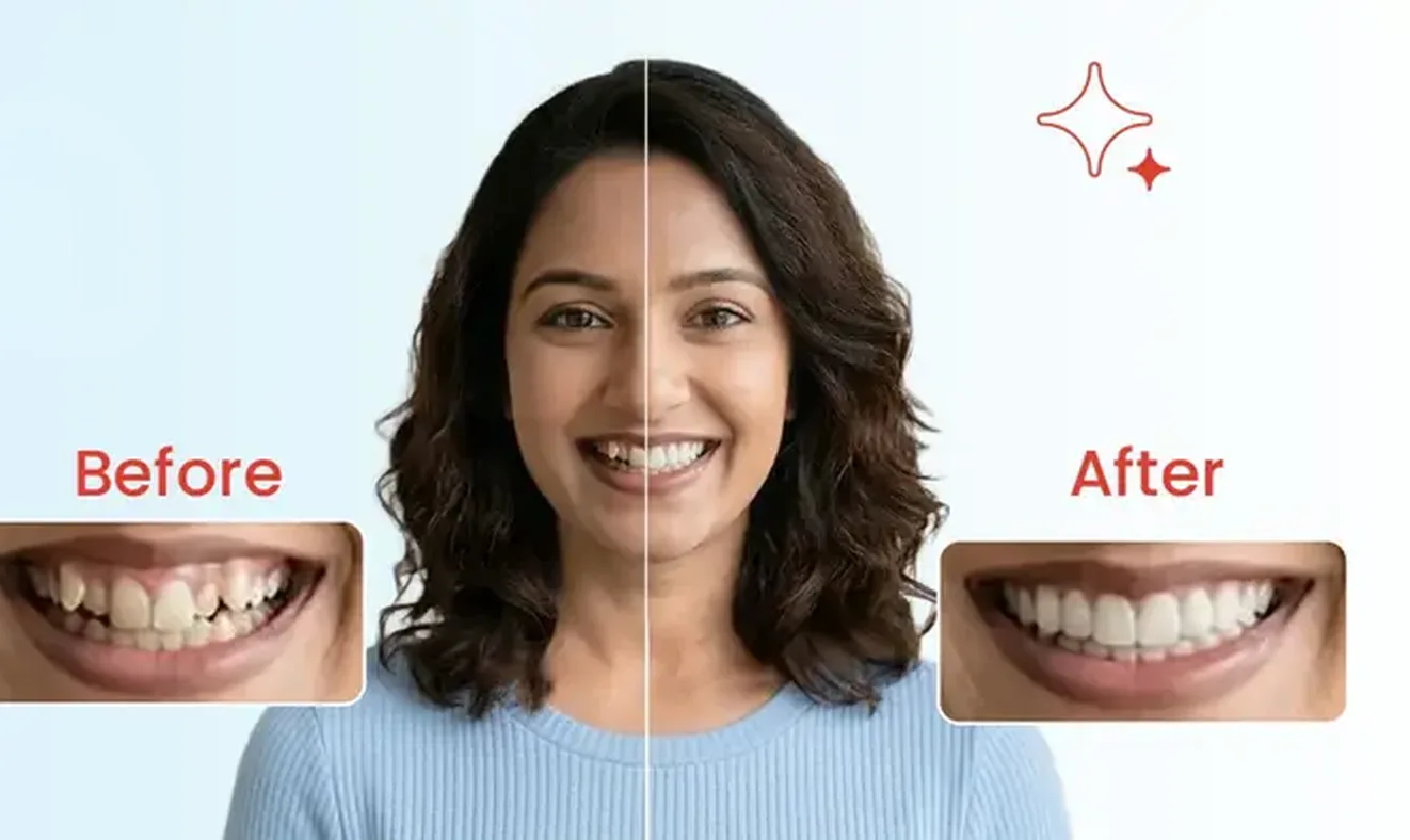 A toothsi campaign creative showing a before and after smile comparison.